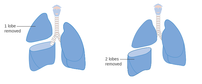 Lobectomy