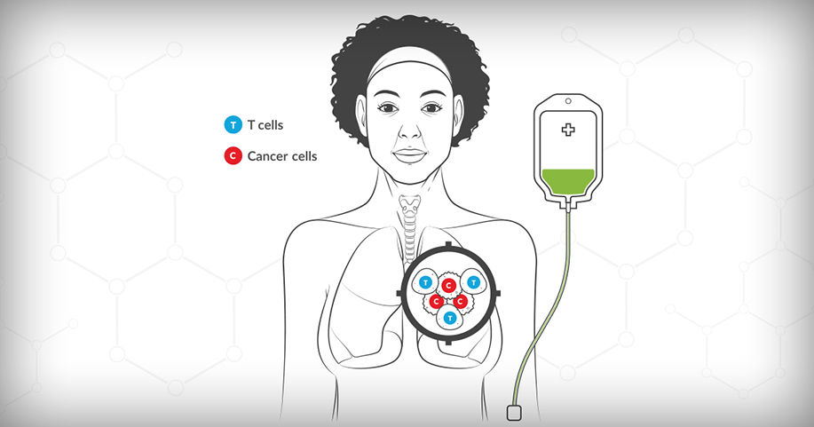 Lung Cancer Immunotherapy American Lung Association